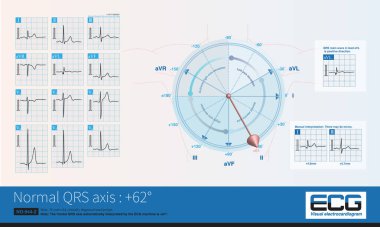 Ön eksen + 62 olduğunda, maksimum QRS depolarizasyon potansiyeli kurşunun eksenine en yakın olduğu için R-dalgası genliği en yüksek olandır..