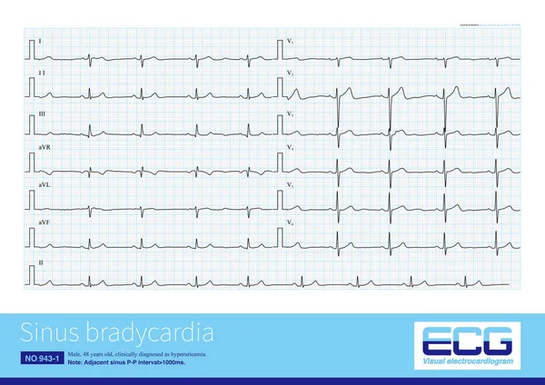 Generally Sinus Heart Rate Beats Minute Called Sinus Bradycardia Arrhythmia — Stock Photo, Image