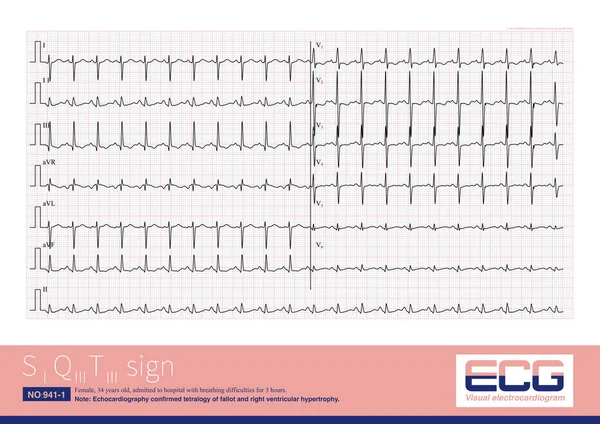Sinal Sqt Uma Alteração Eletrocardiográfica Doença Cardíaca Direita Que Não — Fotografia de Stock