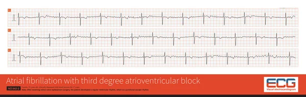 Cardiac surgery is one of the common causes of iatrogenic atrioventricular block. Once atrial fibrillation exhibits a slow and regular ventricular rhythm, it is important to be alert to 3 AVB.
