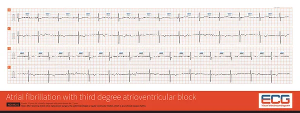 Cardiac surgery is one of the common causes of iatrogenic atrioventricular block. Once atrial fibrillation exhibits a slow and regular ventricular rhythm, it is important to be alert to 3 AVB.