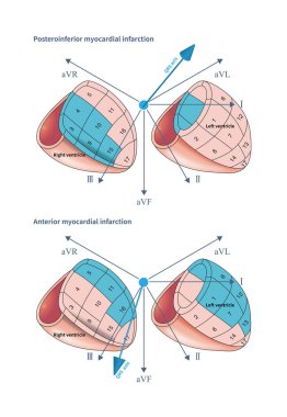 RCA tarafından posterior LV 'ye sağlanan kan kütlesi karavanın kütlesini aştığında akut inferior MI da kurşun III' ten daha büyük kurşun II yükseklik genliği ile meydana gelir..