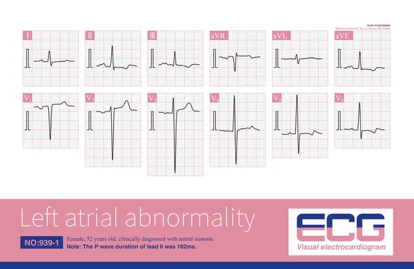Electrocardiogram Characteristics Left Atrial Abnormality Wave Duration Greater 120Ms Wave — Stock Photo, Image