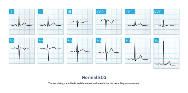 Ritmo Normal Ritmo Sinusal Morfologia Amplitude Duração Cada Onda Eletrocardiograma — Fotografia de Stock