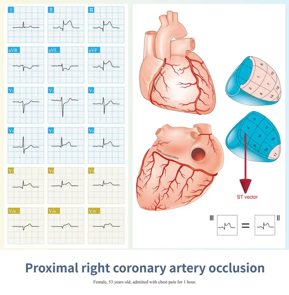 stock image The normal rhythm is sinus rhythm.The morphology, amplitude, and duration of each wave in the electrocardiogram are normal.