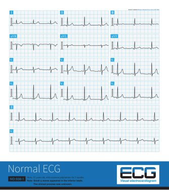 Bazen, orta yaşlı insanlarda, küçük Q dalgaları elektrokardiyogramın alt basamaklarında belirir ve fizyolojik ve eski inferior miyokardiyal enfarktüs arasındaki farkı ayırt etmek gereklidir..
