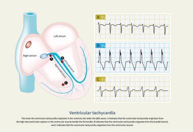 Ventriküler taşikardinin, ventrikül 'ün farklı bölgelerinden kaynaklandığına dikkat çekmek gerekir. Bu da ventriküler taşikardinin kaynağını belirlemeye yardımcı olur..