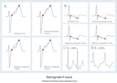 ECG 'de, P-dalgası pozitif bir dalga, negatif bir dalga, iki fazlı bir dalga ya da geriye dönük atriyal depolarizasyon sırasıyla ilişkili bir donanımsal çizgi dalgası olabilir..