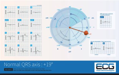 When the frontal axis is -3 , the maximum QRS depolarization potential is closest to the axis of lead , so the R-wave amplitude of lead  is the highest.
