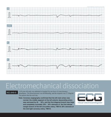 Electromechanical separation is a kind of terminal ECG. The patient's ECG has electrical signals, the ECG wave is widened with morphological abnormalities, and the ventricle has no contraction. clipart