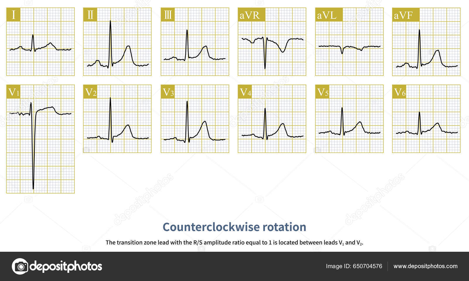 Figure 1 from Counterclockwise and Clockwise Rotation of QRS