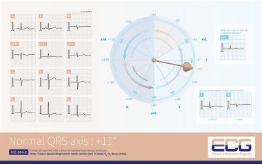 When the frontal axis is + 11 , the maximum QRS depolarization potential is closest to the axis of lead , so the R-wave amplitude of lead  is the highest.