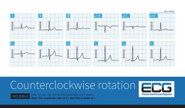 Bu elektrokardiyogramda kurşun V1 'in R: S genlik oranı 1' e yakındır ve saat yönünün tersine önemli bir dönüş gösterir..