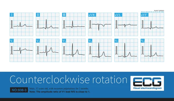 Note Que Neste Eletrocardiograma Razão Amplitude Eletrodo Está Próxima Indicando — Fotografia de Stock