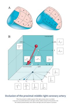 RCA 'nın proksimal-orta bölümü tıkandığında, sağ alt septumdaki iskemi soldakinden daha şiddetli olur ve kurşun II' deki ST segment yükselmesi kurşun II 'dekinden daha büyüktür..