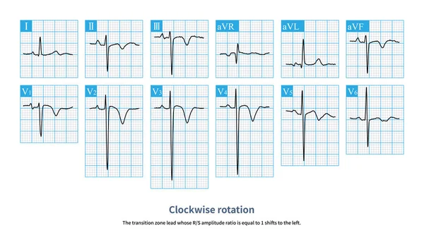 Egy Tüdőembóliás Beteg Elektrokardiogramja Kimutatta Hogy Jobb Kamra Túlterhelt Volt — Stock Fotó