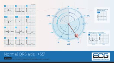 Bazen, genç ve orta yaşlı kadınlarda elektrokardiyogramın ST segmenti, çoğu fizyolojik ST segmenti depresyonuna ait, yükselen bir eğik depresyon gösterir..