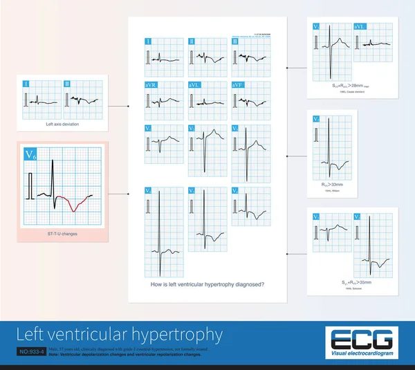 Alterações Comuns Ecg Hipertrofia Ventricular Esquerda Incluem Aumento Amplitude Das — Fotografia de Stock
