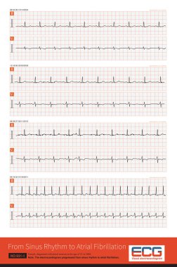 Klinik pratikte mitral stenoz atriyal fibrilasyona neden olan yaygın bir hastalıktır. Bu mitral stenozlu bir kadının 7 yıllık elektrokardiyogramı..