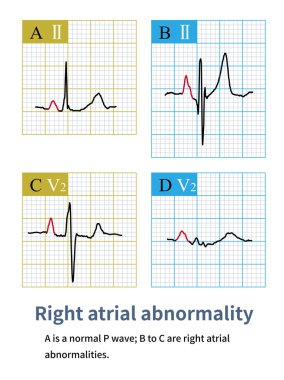 Sağ atriyal anormalliğin elektrokardiyogramı P dalgası genişliğinde bir artıştır, kol ve göğüs uçları 2.5 mm 'yi geçmiştir..