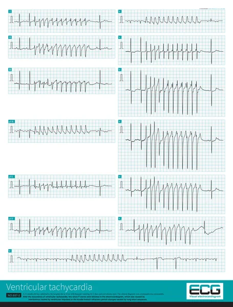 Counterclockwise Rotation Common Electrocardiogram Phenomenon