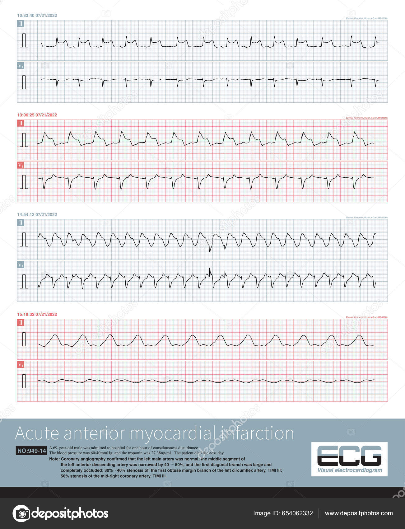 Seorang Pasien Dengan Anterior Ekstensif Akut Dan Inferior