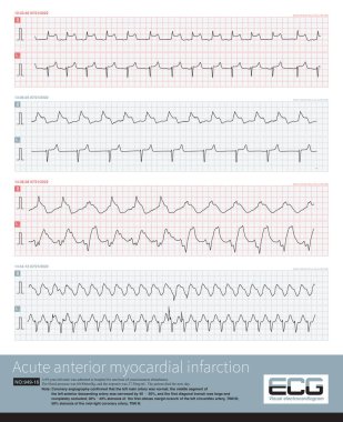 Akut anterior ve inferior miyokardiyal enfarktüsü olan bir hasta iki çeşit QRS kompleksi geliştirdi ve ardından ventriküler taşikardi gelişti..
