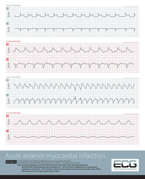 A patient with acute extensive anterior and inferior myocardial infarction developed ventricular tachycardia and quickly experienced cardiac arrest.