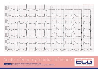 Erkek, 66 yaşında, 3 saat boyunca göğüs ağrısı şikayetiyle hastaneye yatırılmış. EKG akut miyokardiyal enfarktüs gösterdi. Koroner anjiyografi aort diseksiyonu doğrulandı..