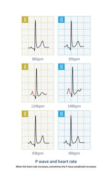 Kalp hızı arttığında, bazen P dalgası genliği artar. Bu fizyolojik bir olgudur, sağ atriyal anormalliği teşhis etme..