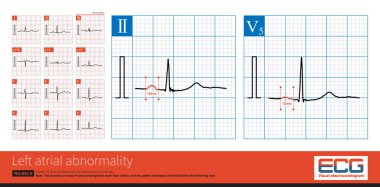 Kadın, 57 yaşında, 6 yıl önce mitral stenoz teşhisi konmuş. Bu EKG çekildiğinde hasta sinüs ritmini korudu ve bir sonraki yıl atriyal fibrilasyon geliştirdi..