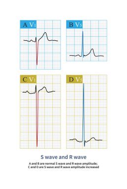 A ve B normal S dalgası ve R dalga genişliğidir; C ve D, sol ventriküler hipertropi vakasının S dalgası ve R dalgasıdır..