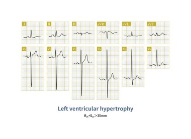 Erkek, 48 yaşında, klinik olarak genişlemiş kardiyomiyopati teşhisi konmuş. ECG 'nin kurşun V5' indeki R dalgaları sol ventriküler hipertrofi gösteriyor..