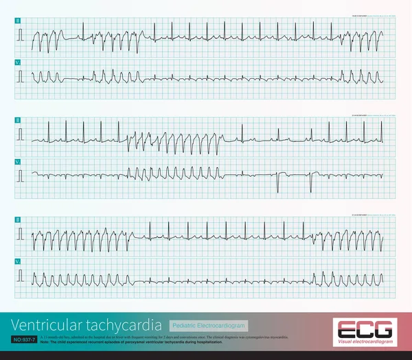 Ventricular tachycardia Stock Photos, Royalty Free Ventricular ...