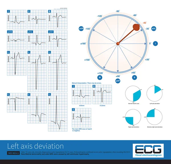 Electrocardiogram Left Ventricular Hypertrophy Left Axis Deviation Qrs Electrical Axis — Foto de Stock