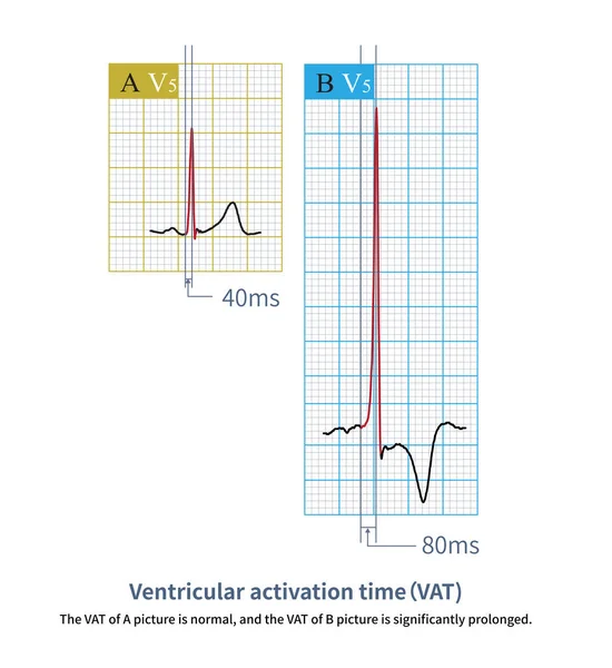 stock image The left ventricular wall activation time is the time interval measured from the beginning of the QRS wave to the peak of the R wave.