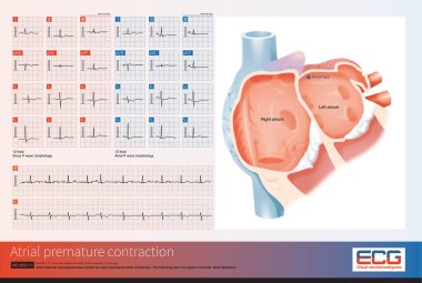 Kadın, 57 yaşında, 6 yıl önce mitral stenoz teşhisi konmuş. Bu elektrokardiyogramda atriyal prematüre kasılma var. Sağ üst akciğer damarında kökenini gösteriyor..
