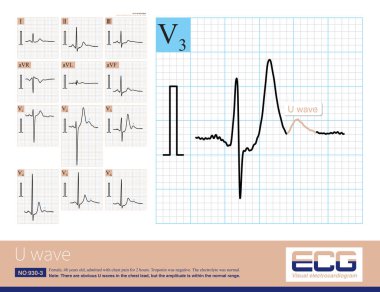 U-dalgası T-dalgasını takip eden düşük genlikli elektrokardiyogramdır ve genliği 3.3 metreyi geçmez. Maksimum genlik genellikle V2-V4 kablosunda görülür.