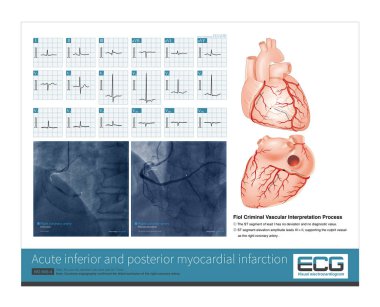 Erkek, 68 yaşında, 7 saat boyunca göğüs ağrısı. Koroner anjiyografi sağ distal koroner arterin tıkandığını gösteriyor. Hasta başarılı bir şekilde koroner stent takıldı..