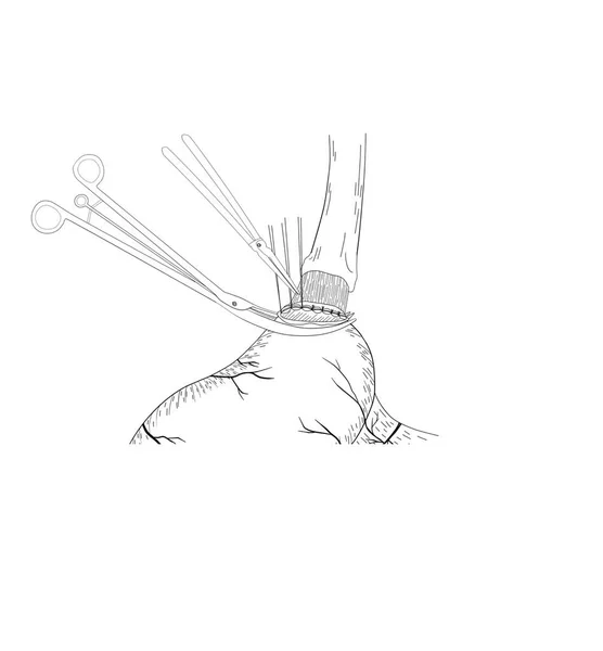 Gastro Oesofageale Anastomose Chirurgie Deze Medische Illustratie Toont Anastomose Techniek — Stockfoto