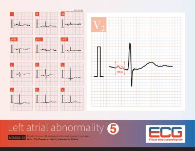 56 yaşında kadın, 5 yıl önce mitral stenoz teşhisi konmuş. Bu EKG çekildiğinde hasta sinüs ritmini korudu. P dalgasının genişlettiğine dikkat edin..