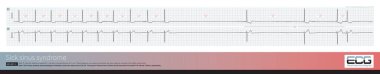 81 yaşındaki yaşlı bir erkeğe klinik olarak koroner kalp hastalığı ve serebral damar yetersizliği teşhisi kondu. Dinamik elektrokardiyogram hastalıklı sinüs sendromu olduğunu gösteriyor..