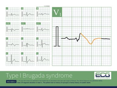 Kadın, 70 yaşında, klinik olarak pulmoner bulla teşhisi konulmuş. Birinci tip Brugada deseni EKG 'nin sağ göğüs uçlarında görünüyor ve EKG değişikliklerinin takip edilmesi gerekiyor..