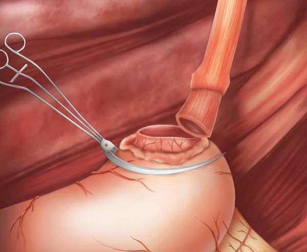 Χειρουργική Αναστόμωσης Αυτή Ιατρική Απεικόνιση Δείχνει Την Τεχνική Αναστόμωσης Του — Φωτογραφία Αρχείου