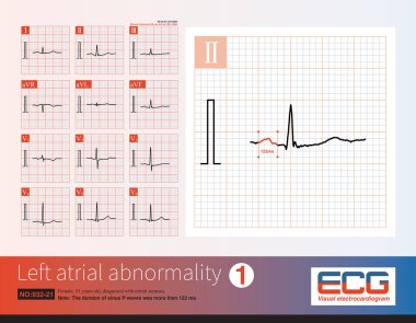 Kadın, 51 yaşında, mitral stenoz teşhisi konulmuş. Bu EKG çekildiğinde hasta sinüs ritmini korudu. P dalgasının genişlettiğine dikkat edin..