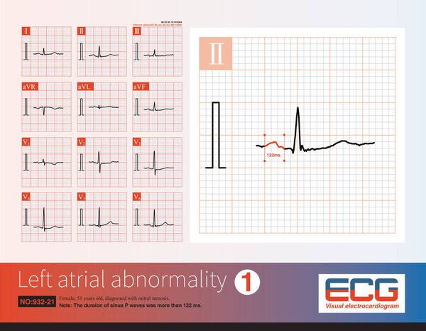 Female, 51 years old, diagnosed with mitral stenosis. When this ECG was taken, the patient still maintained sinus rhythm.Note that the P wave duration was widened.