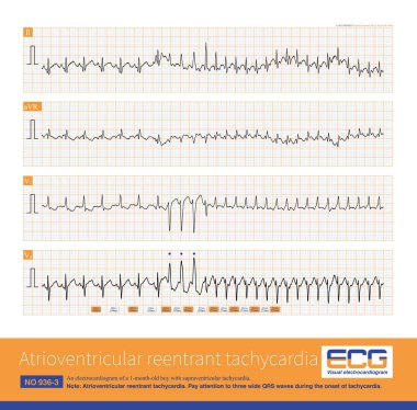 1 aylık bir çocukta atrioventriküler taşikardi gelişti. Taşikardi saldırısının başlangıcında, üç geniş çaplı QRS dalgası başarılı bir şekilde ortaya çıktı..