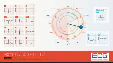 Ön eksen + 19 olduğunda, maksimum QRS depolarizasyon potansiyeli kurşunun eksenine en yakındır, yani R-dalgası genişliği, kurşunun en yüksek.