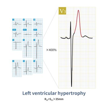 Sol ventriküler hacim arttığında, ECG sadece sol ventriküler hipertroptaki değişiklikleri göstermez, aynı zamanda T dalgasının genliğini de arttırır..