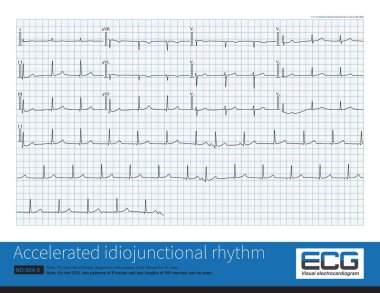Erkek, 76 yaşında, klinik olarak kalp rahatsızlığı teşhisi konmuş. EKG sinüs ritminin ve hızlı kavşak ritminin değişken olduğunu gösterdi..